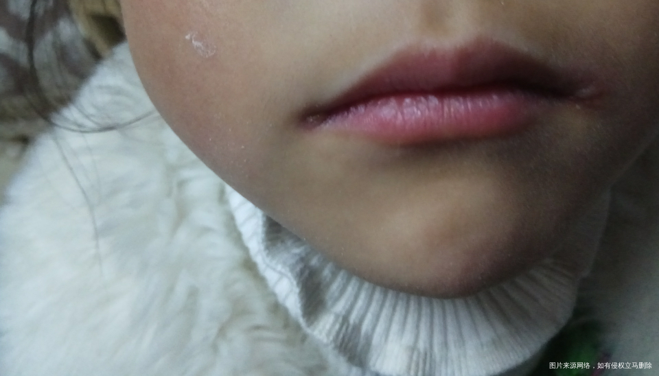 孩子发烧后嘴角两边长了脓泡 是不是上火了