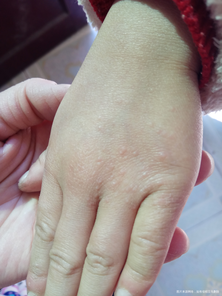 孩子手上长了些水泡 是什么情况 怎么才能好
