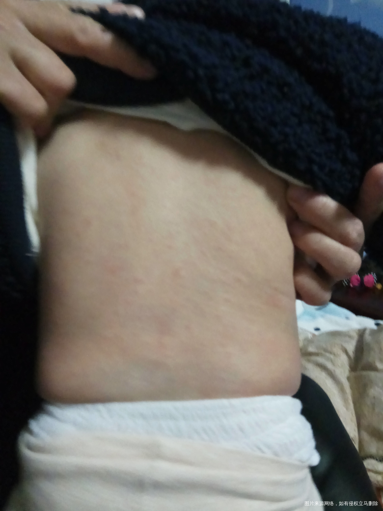 谁家宝宝出过幼儿急疹的 进来看看