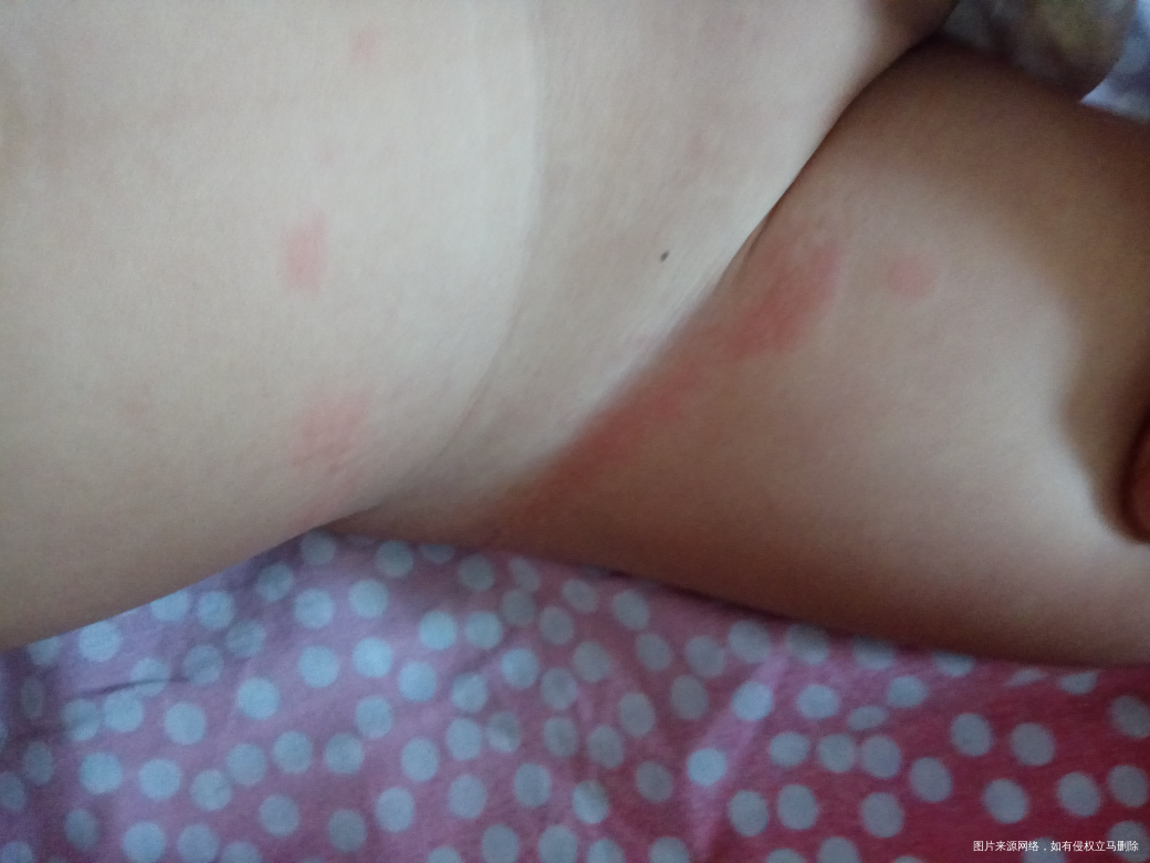 孩子白天突然发烧 喂了点退烧药好了一点 半夜又反复