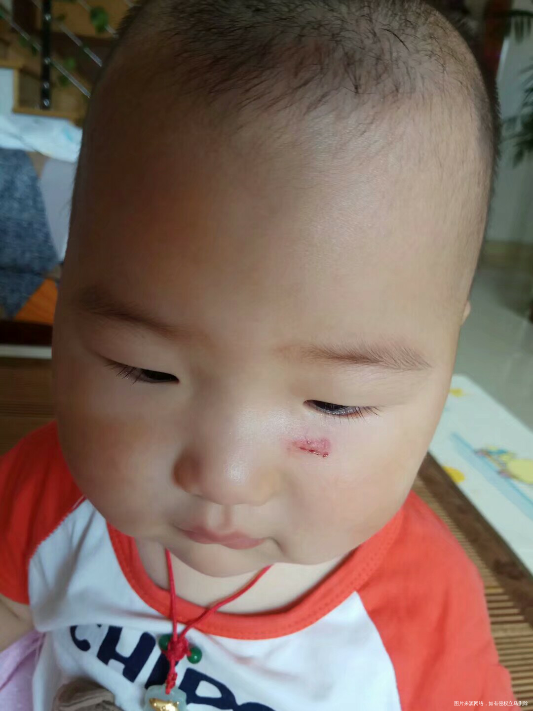 孩子脸被人家咬破了 留疤了怎么办