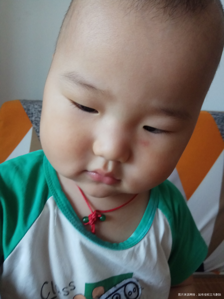 孩子脸被人家咬破皮了 好像留疤了怎么办