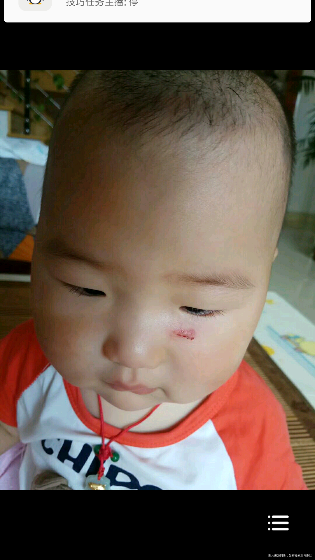 脸上 伤口上长的脂肪粒会自己恢复吗?