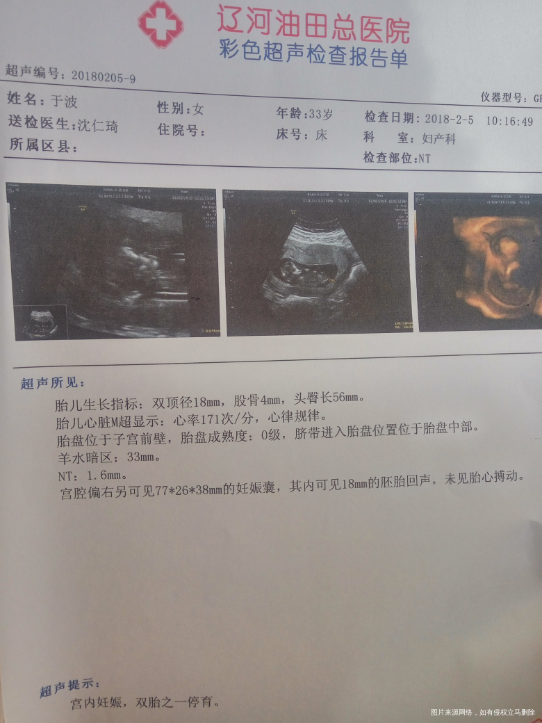 能告诉我,停育的宝宝大约什么时候胎停的吗?谢谢