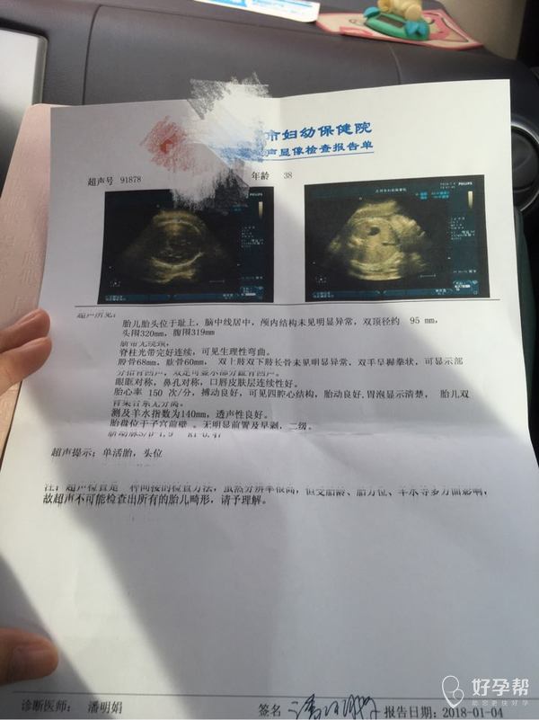 36周的彩超单子医生帮忙看一下