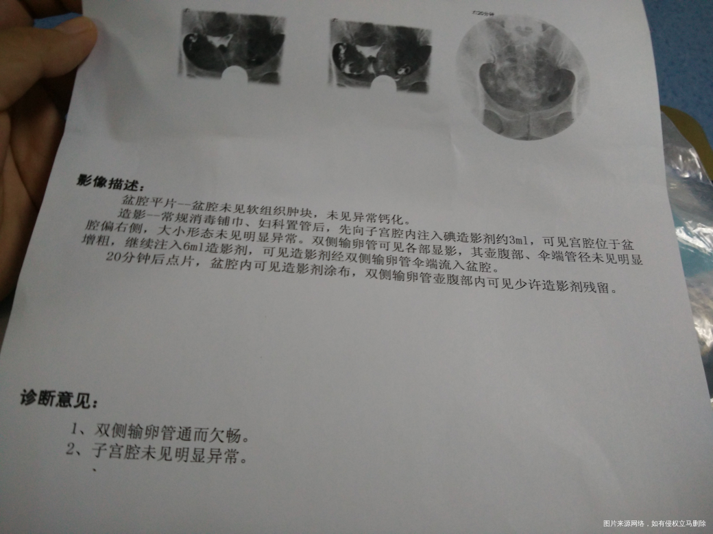 输卵管造影两侧通而不畅