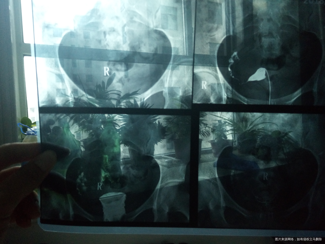 请医生帮我看看输卵管造影片子,求助!