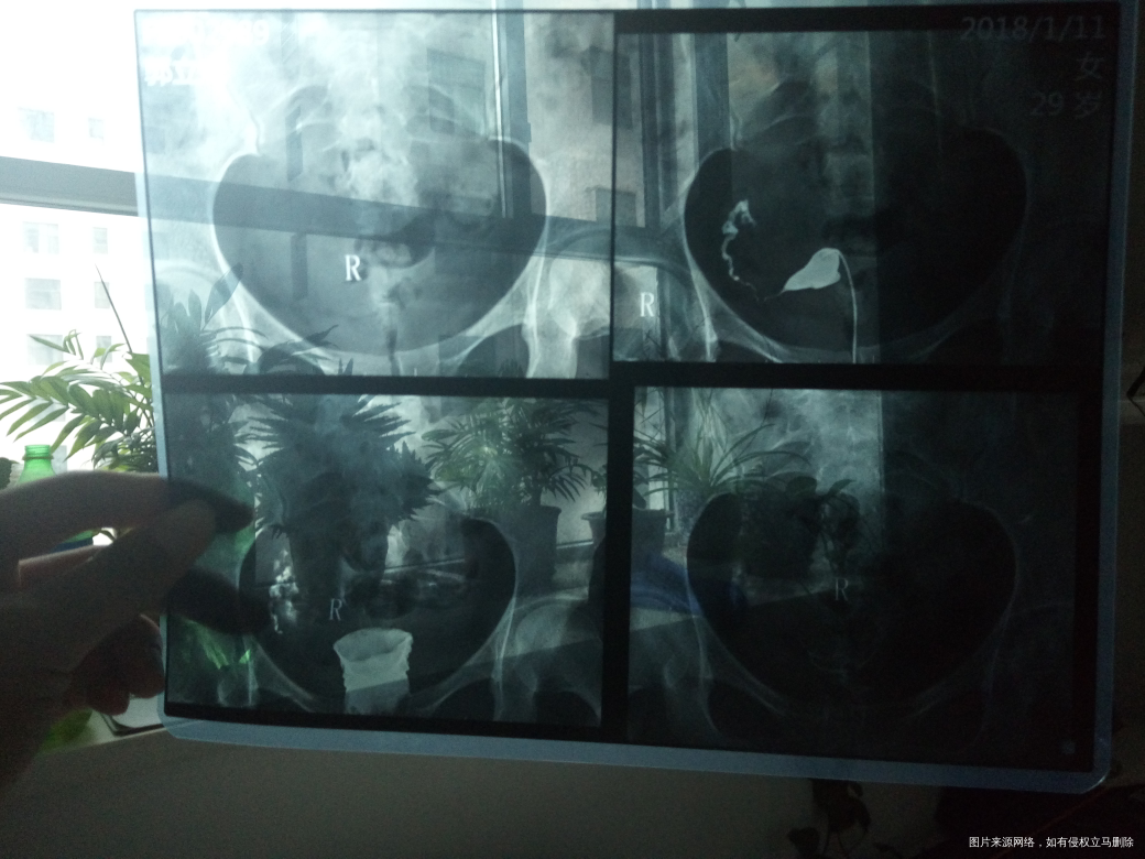 请医生帮我看看输卵管造影片子,求助!