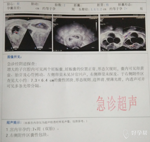 孕囊形态欠规则是胎停育的征兆吗