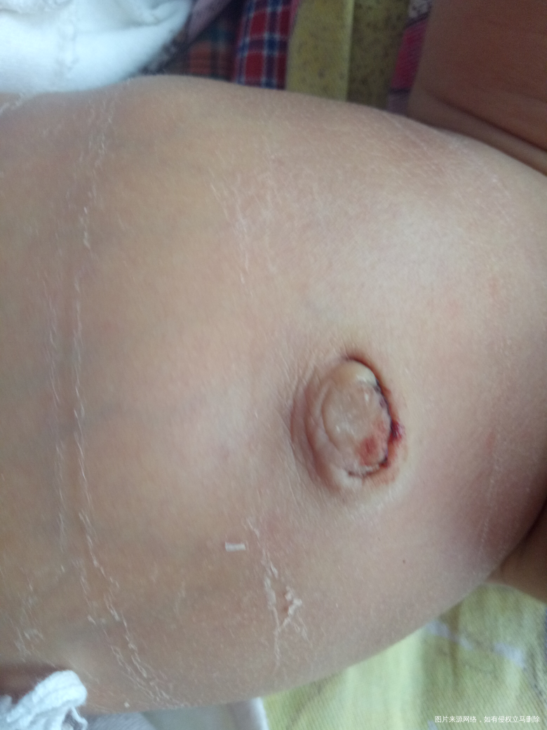 帮忙看看宝宝肚脐眼长的怎么样,需要消毒吗?还有就是宝宝黄疸多少天能没有
