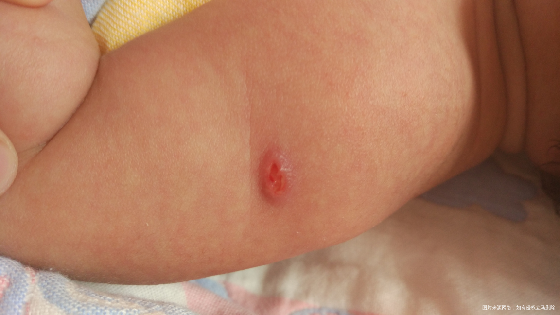 今天洗澡的时候把打疫苗的疤给弄掉了