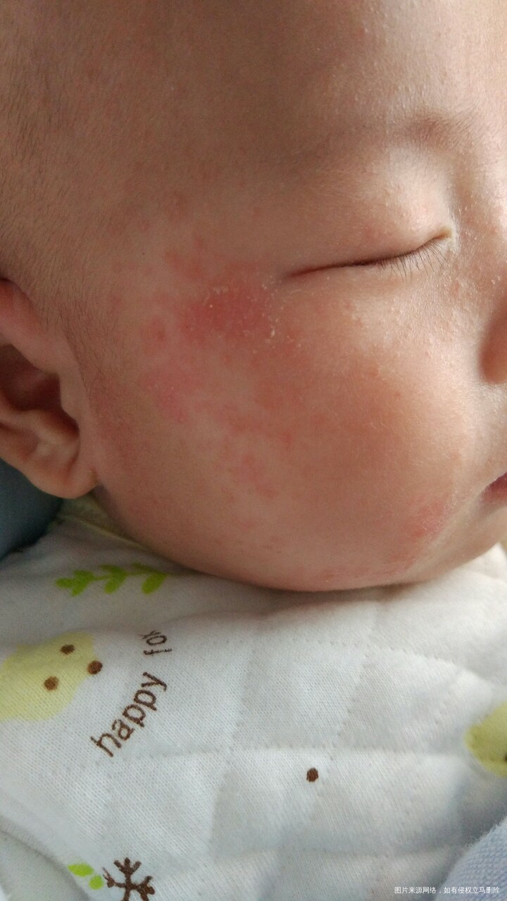 各位宝妈有没有去湿疹的妙招或者好用的药膏?