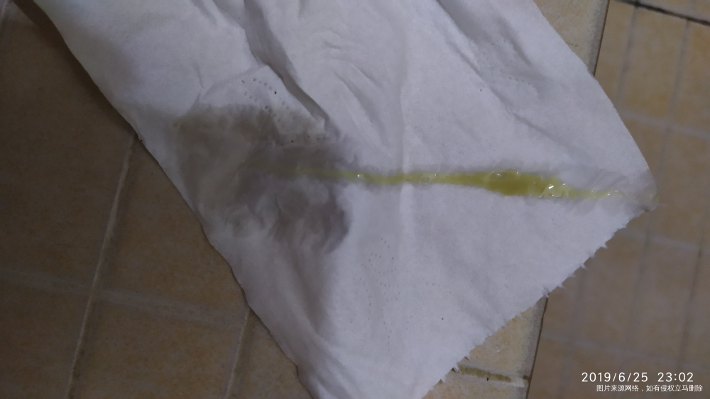 医生帮忙看看白带正常吗