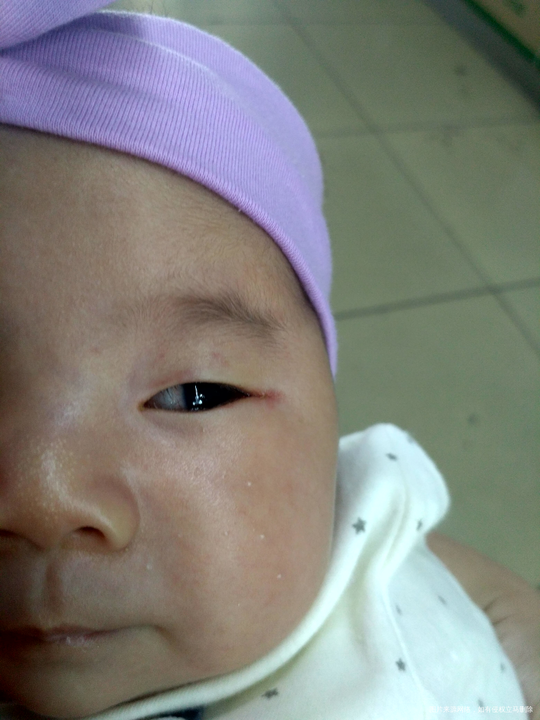 宝宝出生48天了,从出生左眼眼屎多,这几天特别多,眼角还发红。