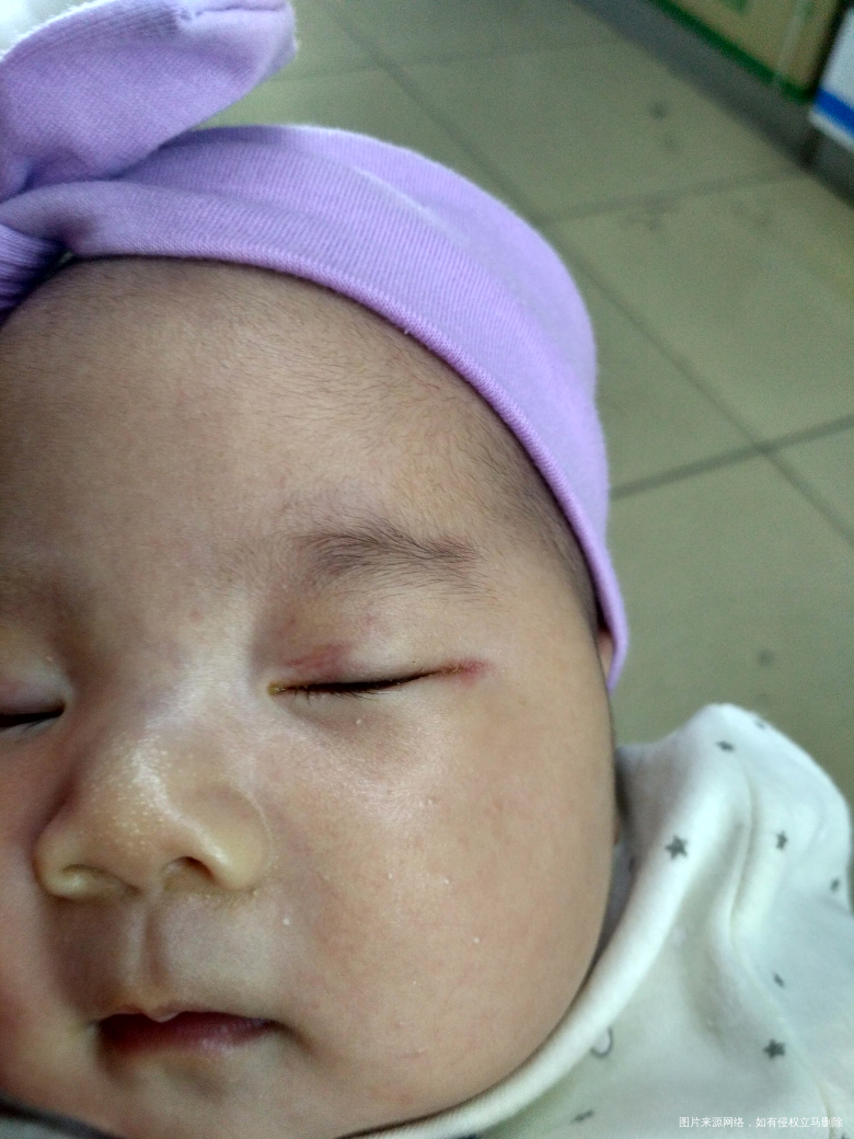 宝宝出生48天了,从出生左眼眼屎多,这几天特别多,眼角还发红。
