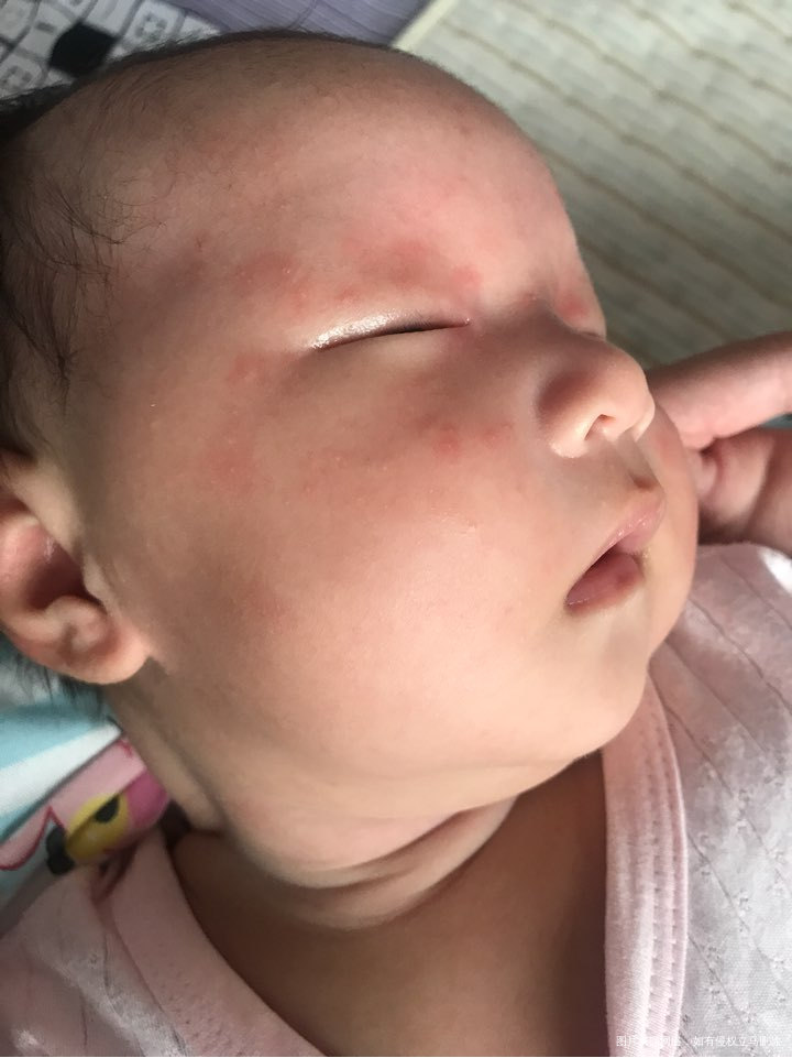 我家宝宝刚满月脸上长了好多疙瘩要不要紧