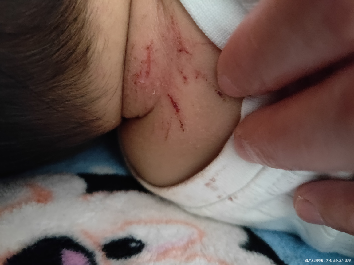 14个月宝宝,脖子周围,左手手腕,右手手丫,有下图症状是什么原因