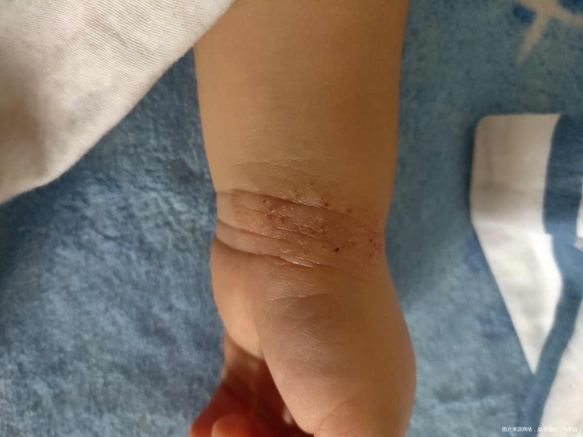 14个月宝宝,脖子周围,左手手腕,右手手丫,有下图症状是什么原因