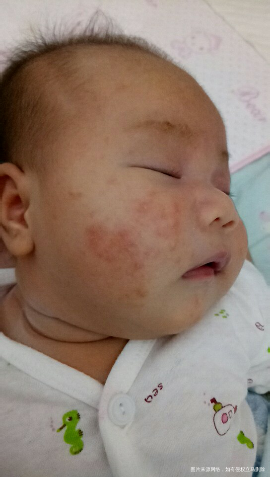 请问一下,医生,我女儿长脸上长了这个是什么?