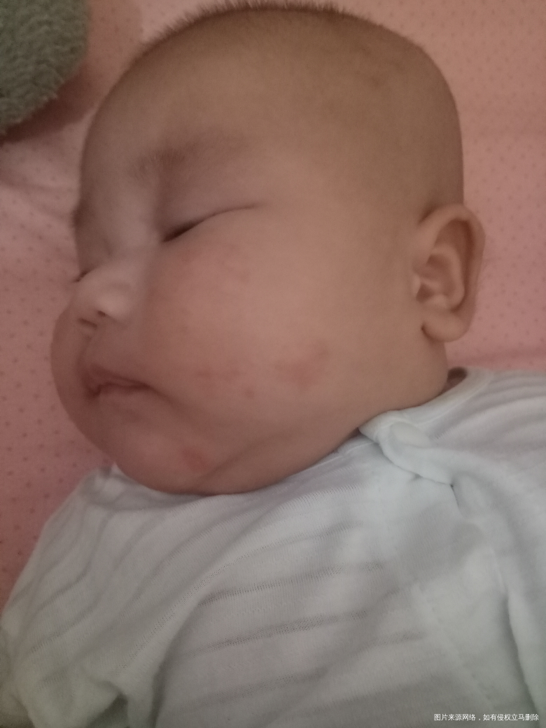 宝宝二个月,脸这个是湿疹还是