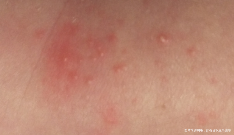 姐妹们,新生儿手脚起水泡怎么回事啊