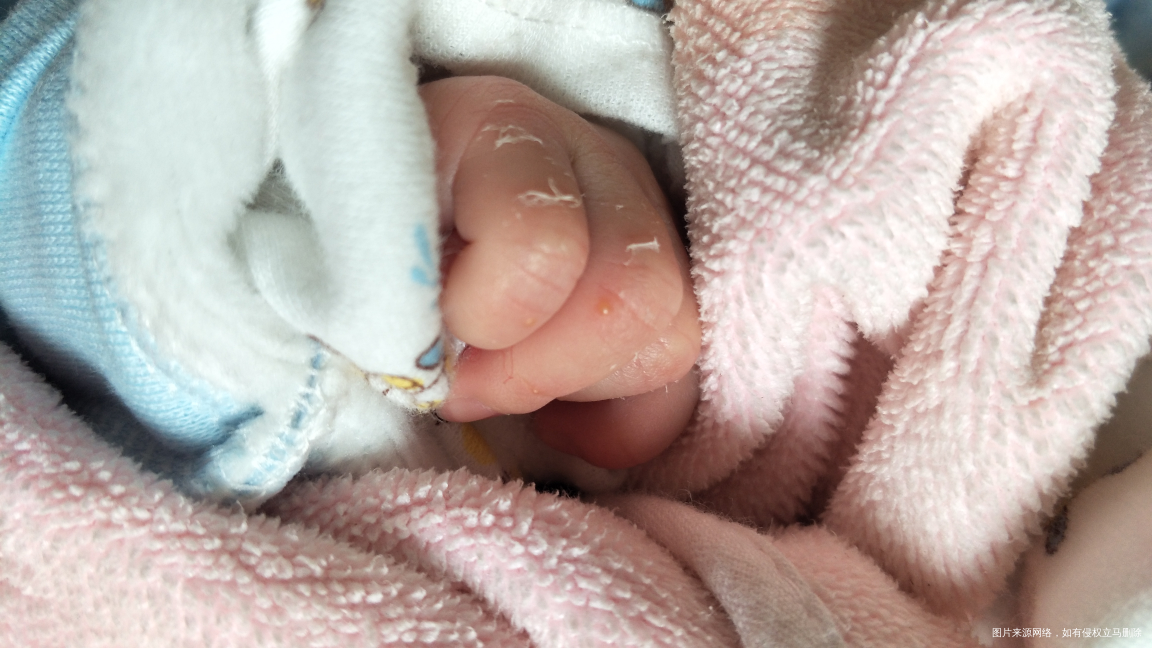 姐妹们,新生儿手脚起水泡怎么回事啊