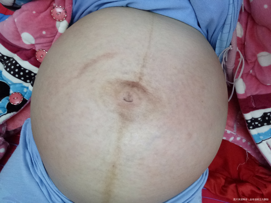 31周的肚子,有青筋是不是要长纹了