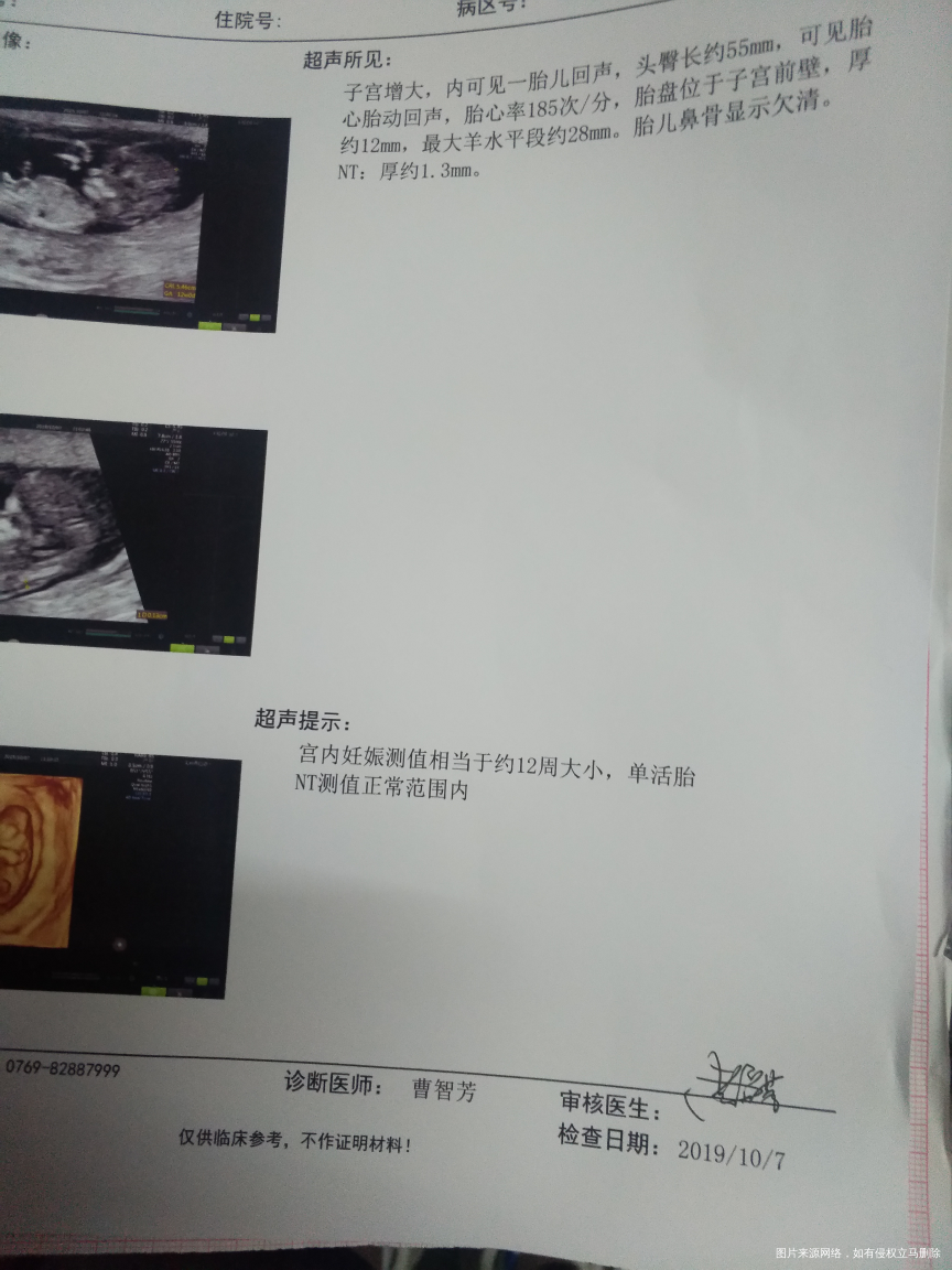 孕12周昨天去nt值是1.3正常,可是显示鼻骨欠清
