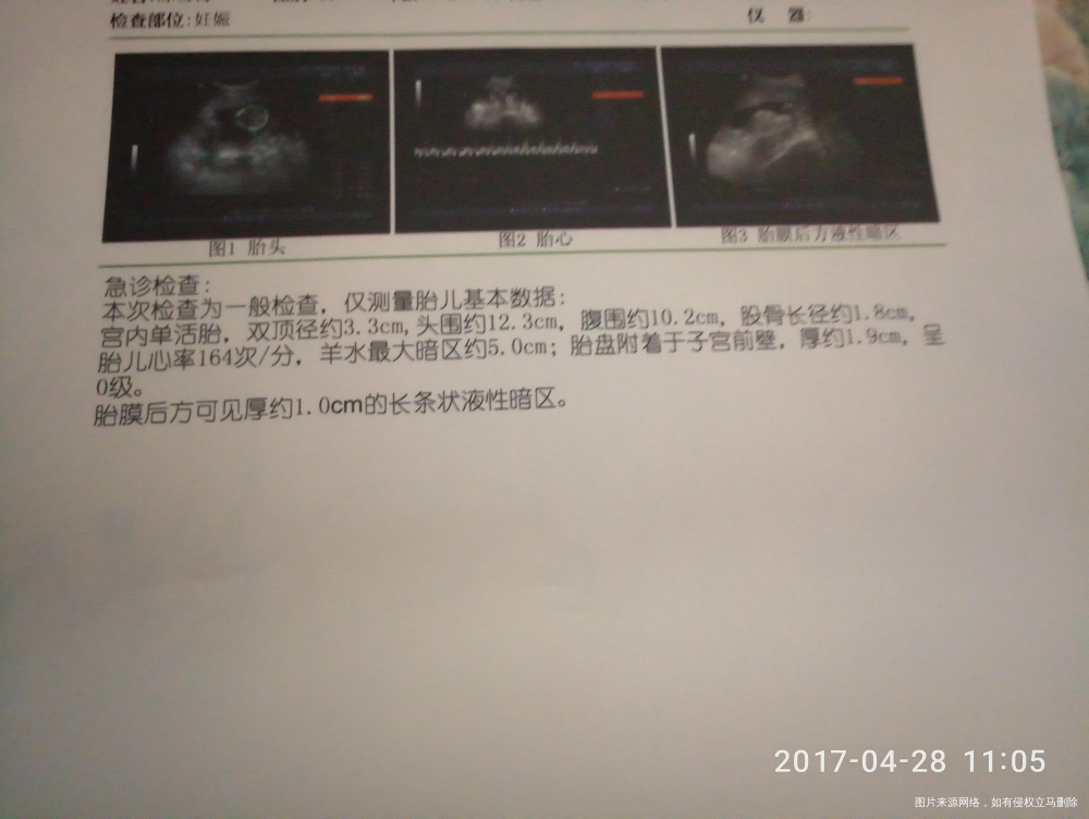胎膜后方有1㎝的长条状液性暗区