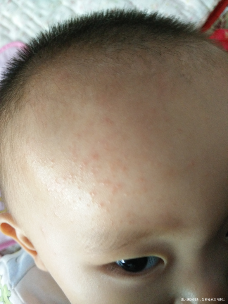 我家宝宝头上起了好多小红疙瘩