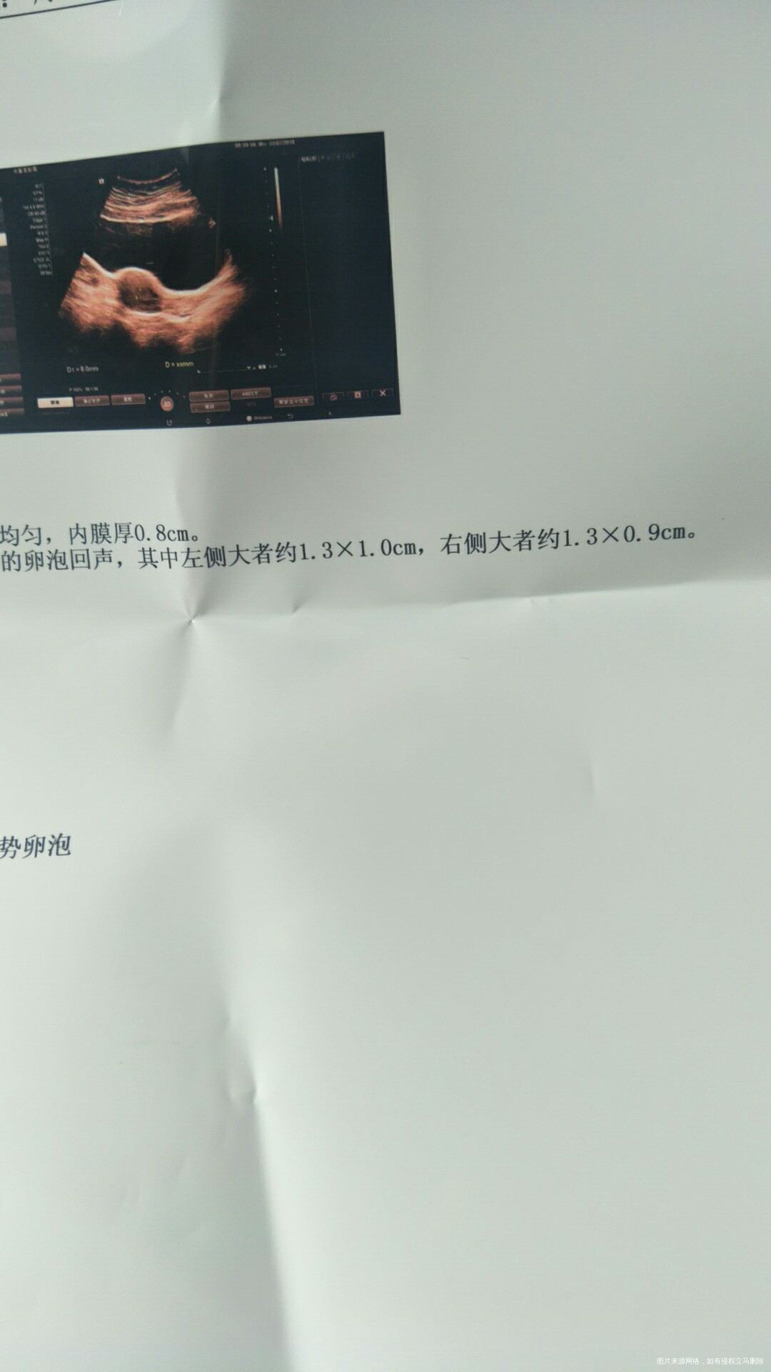 姐妹们有没有谁的卵泡是扁的排卵了??