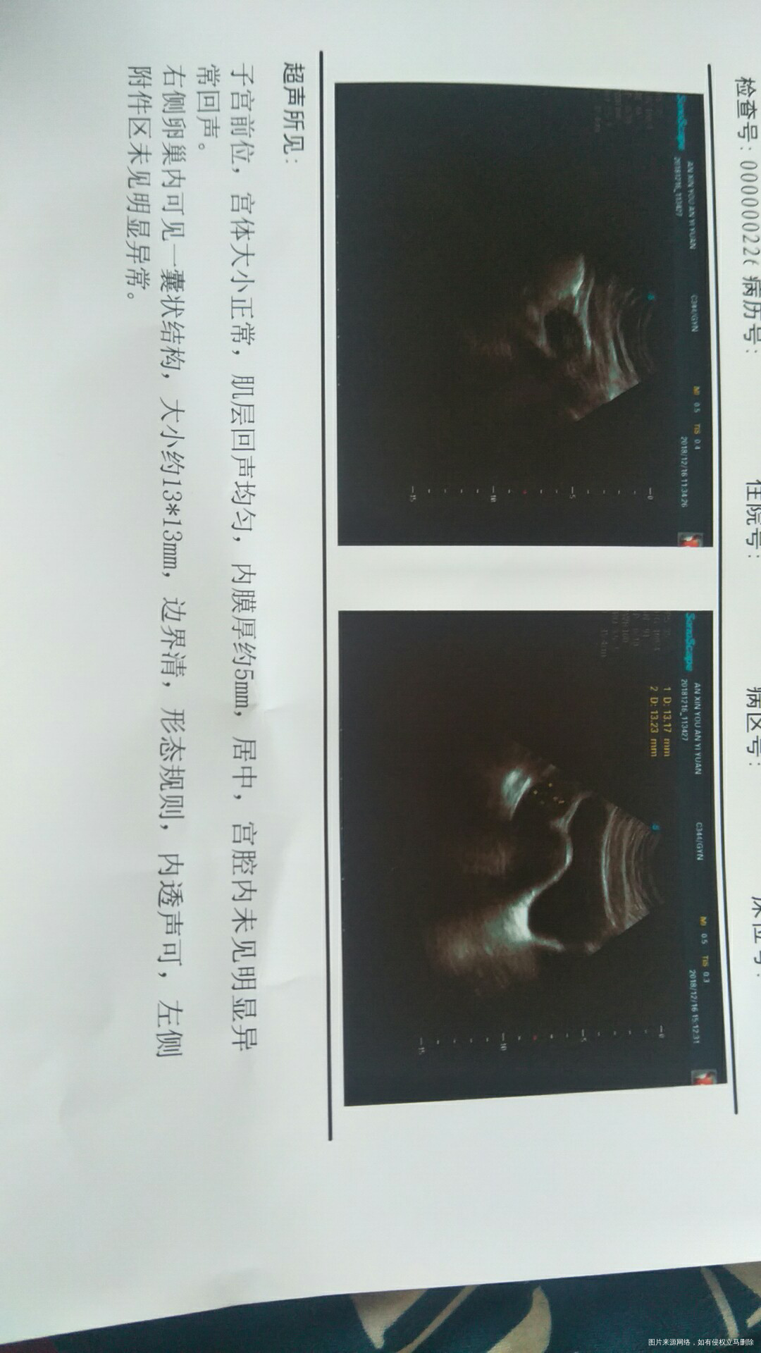 月经结束第五天,促排药完了第三天,帮我看看啥情况!