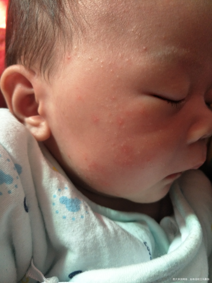 宝宝27天脸上有红疙瘩,怎么回事?