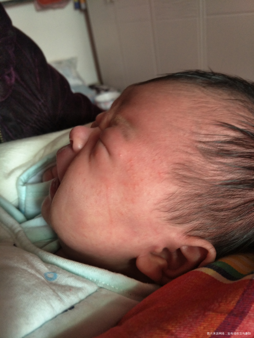 宝宝27天脸上有红疙瘩,怎么回事?