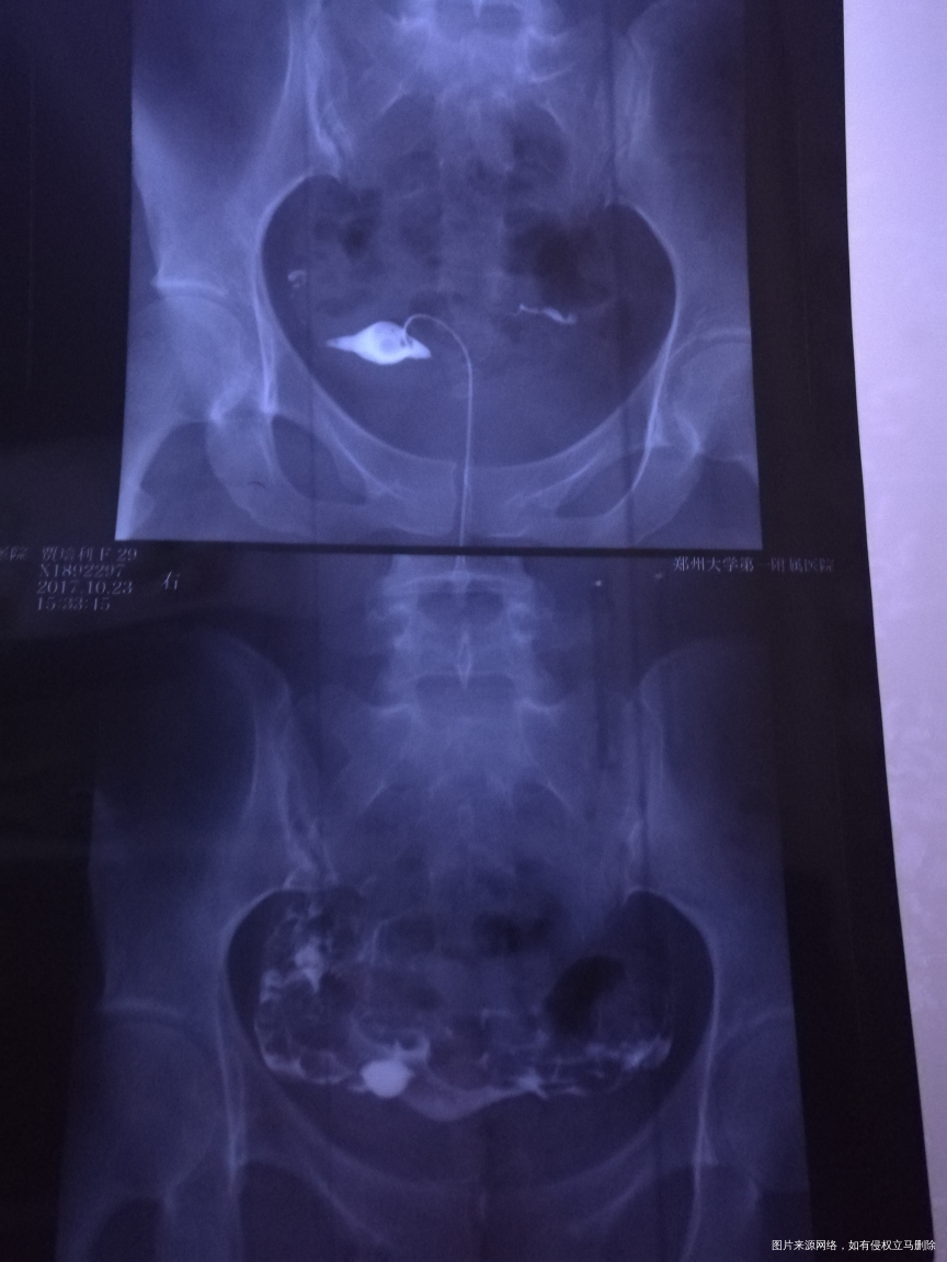 医生帮我看下造影片子???