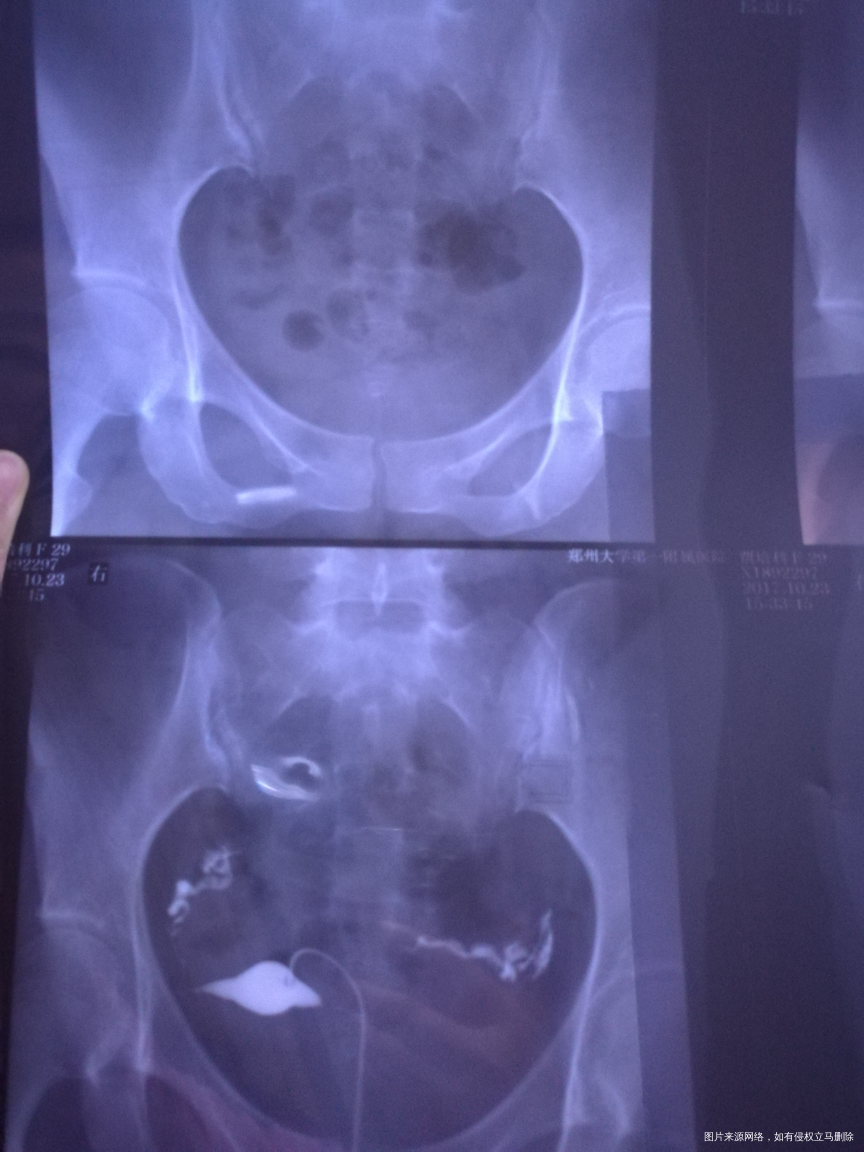 医生帮我看下造影片子???