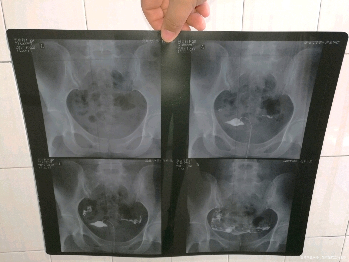 月经第十天右侧卵泡15*13 内膜7.5