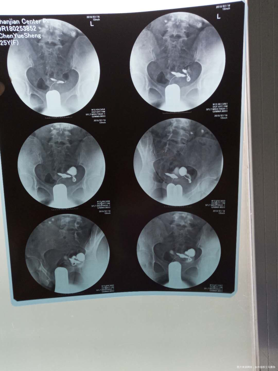 今年的农村医疗没有交到费用,也就是说手术报销不了。