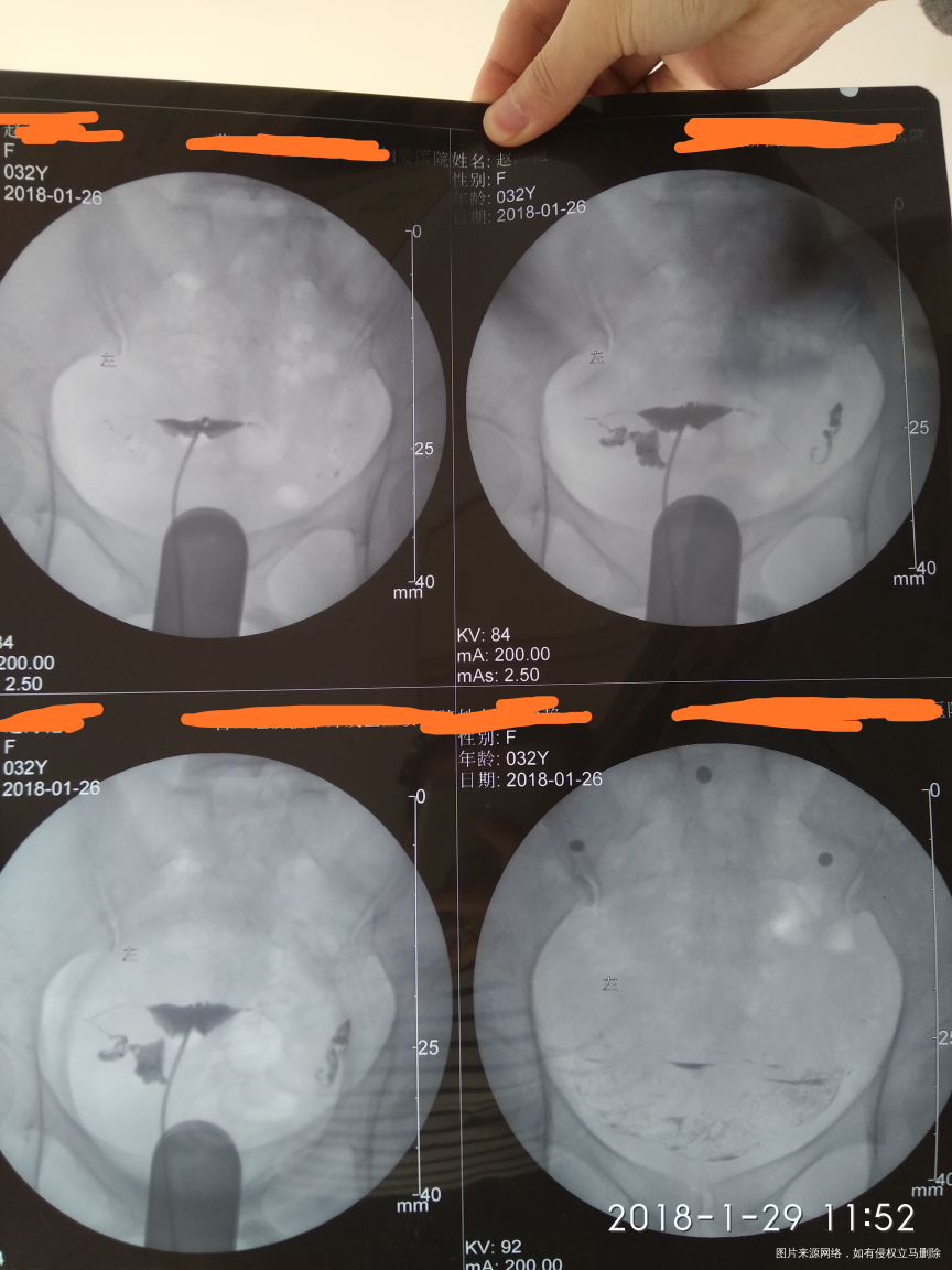 医生好,这是我的输卵管造影片子,请帮我看看我的输卵管情况,万分感谢!