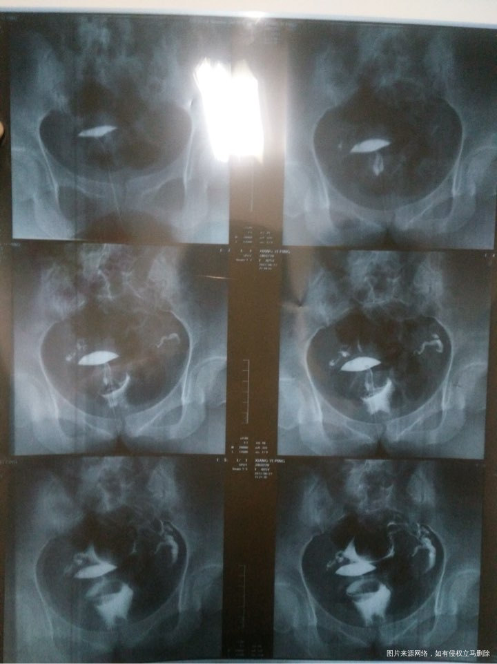 有医生在不、麻烦帮我看看我输卵管造影,严重不、自然受孕几率大不、需要怎样治疗