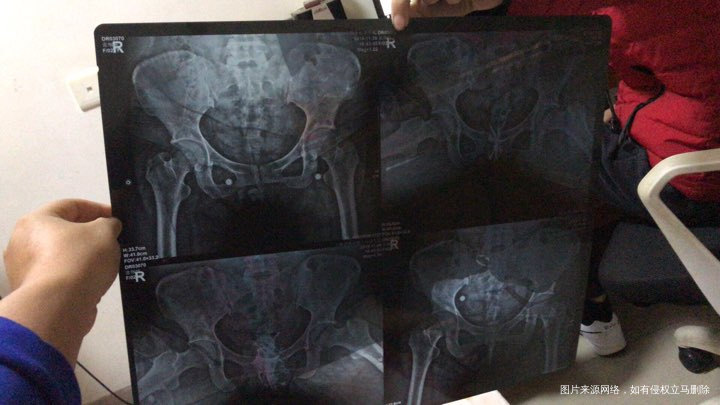 手术后复发了医生看一下得试管还是几率多少