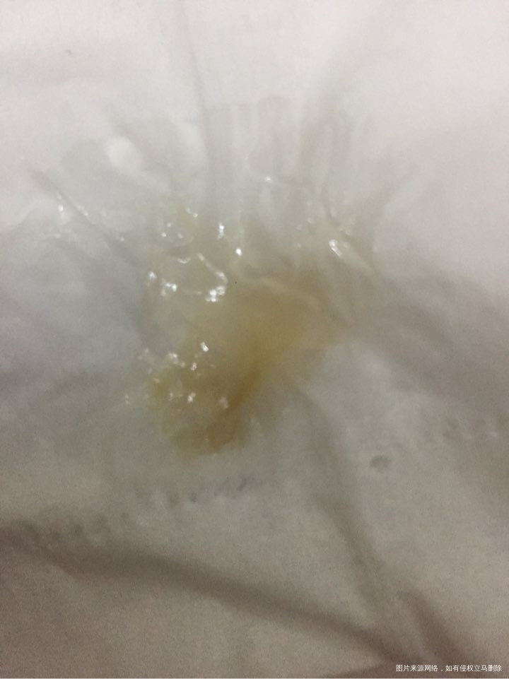 这是白带、还是白带异常、还是排卵期到了