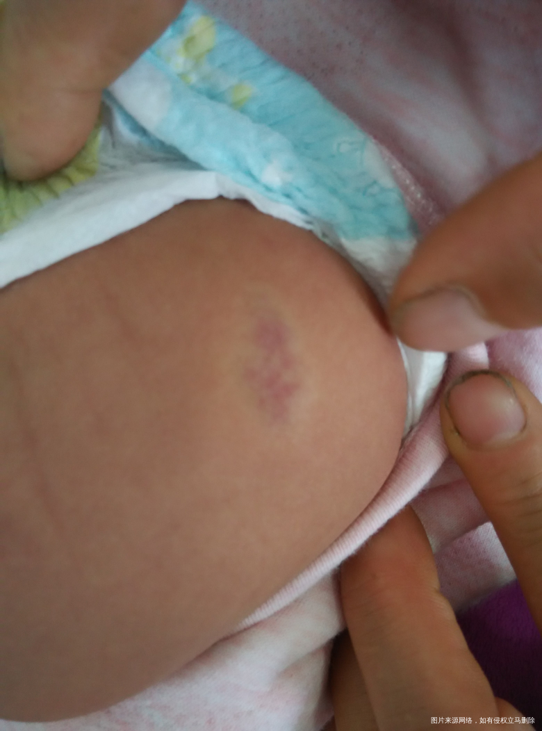 急急 请医生看看我女儿的血管瘤