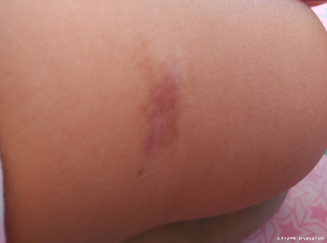 急急 请医生看看我女儿的血管瘤