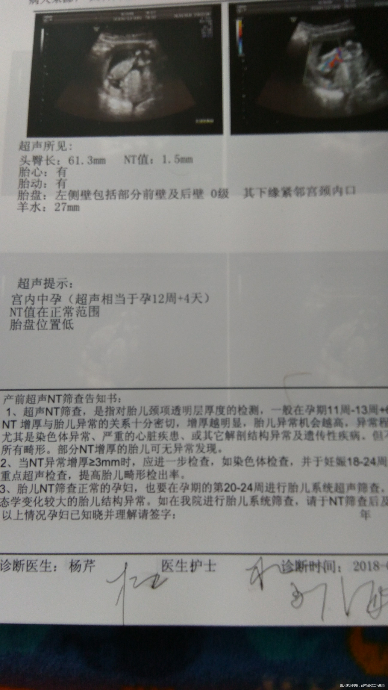 刚做的NT结果,麻烦路过的医生帮忙看看,谢谢