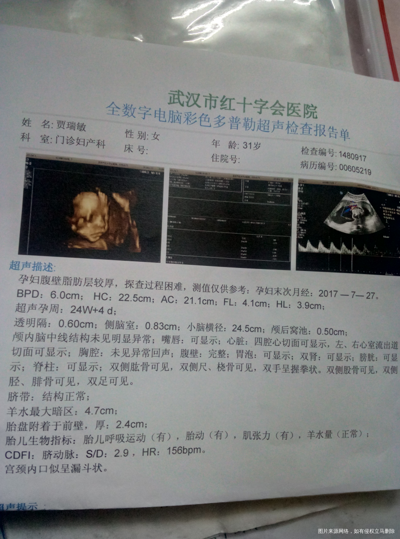 宫颈口呈漏斗状严重么?