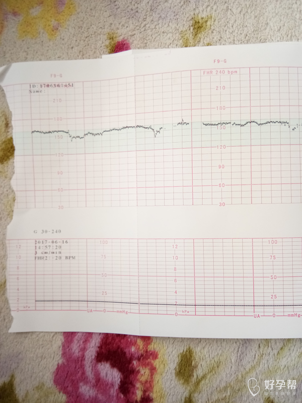怀孕19周加做胎心监测医生说胎心率太平稳