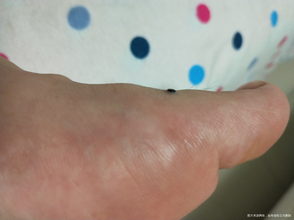 我孕晚期31w请问医生,我脚上这个包需要处理吗?是什么