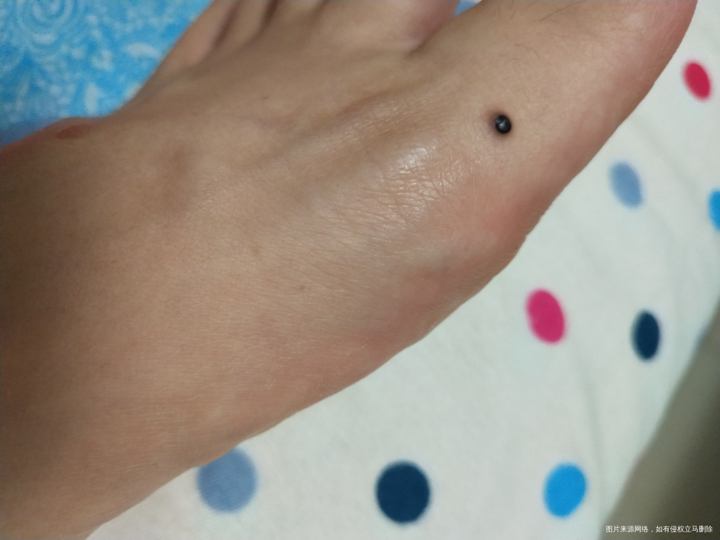 我孕晚期31w请问医生,我脚上这个包需要处理吗?是什么