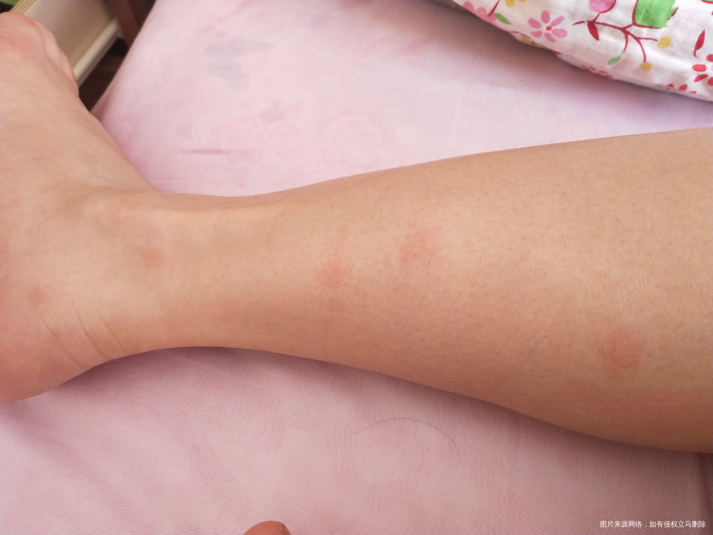 求助医生,我怀孕33周了身上长包了,特痒